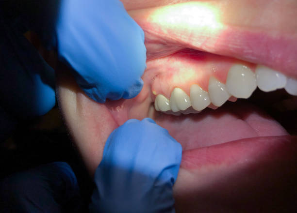 Best Emergency Dental Extractions in Saks, AL
